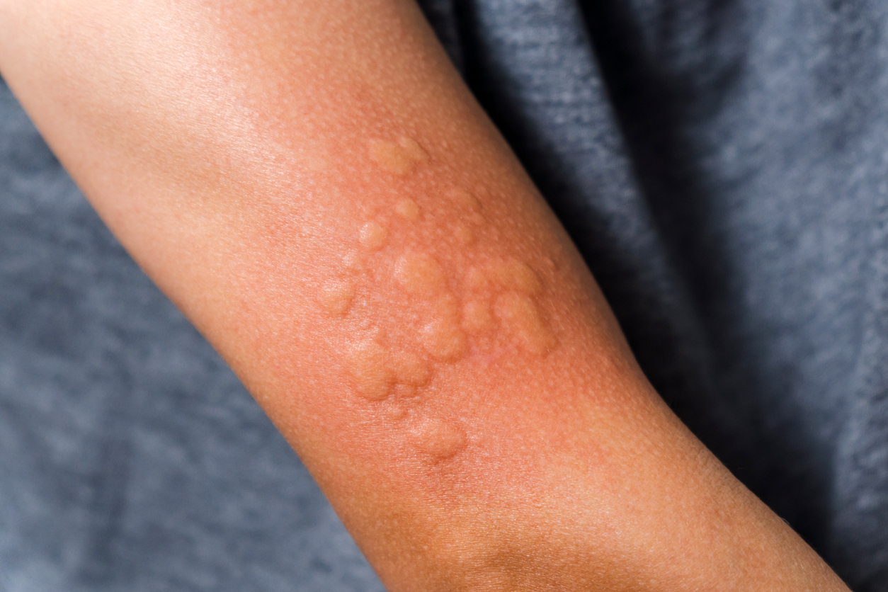 Urticaria Chennai