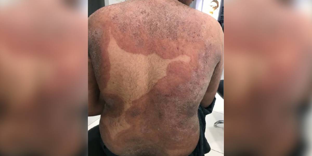 T indotineae Why are experts frowning at the name of a skin fungus linked to India?