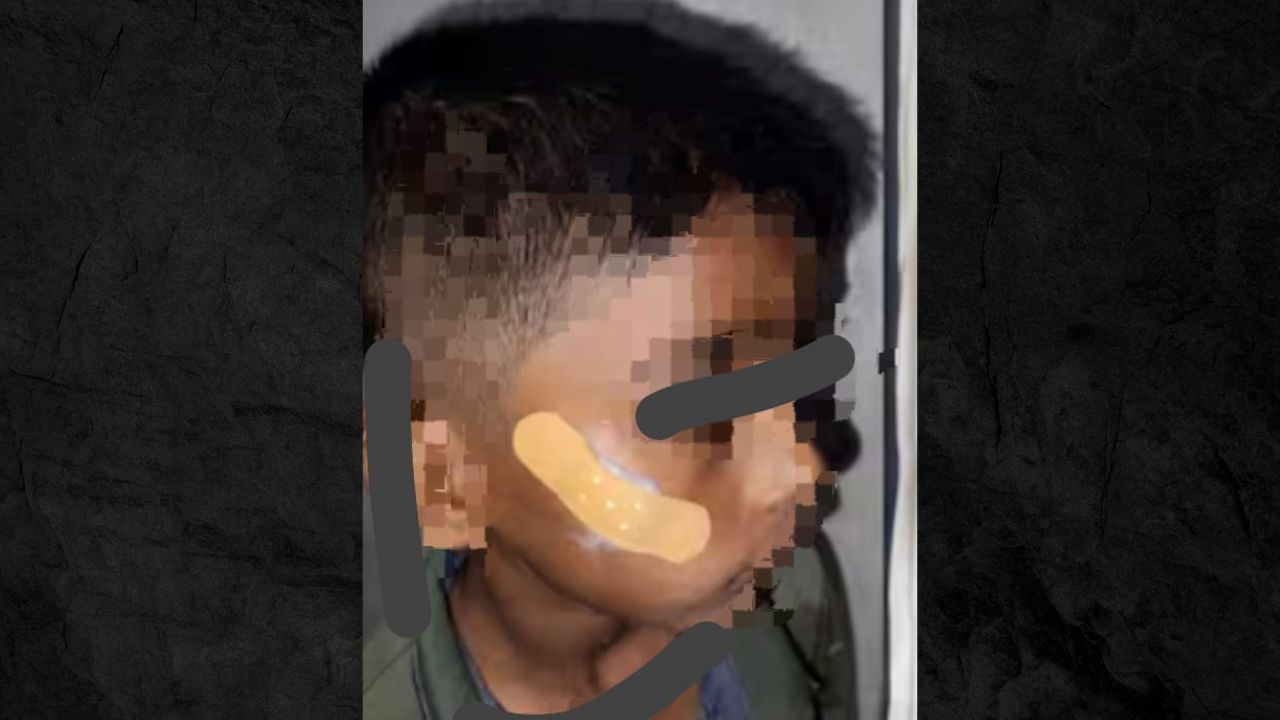 Haveri nurse Karnataka nurse uses Feviquick to seal boy’s cheek wound instead of stitches