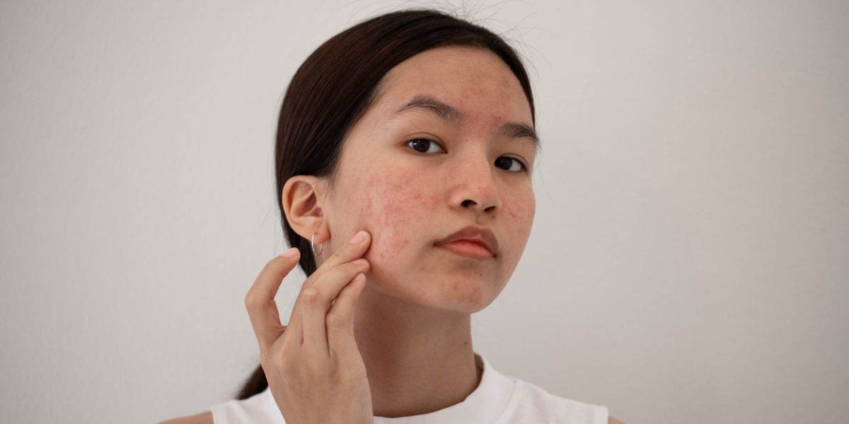 Face acne. (iStock) Thyroid issues