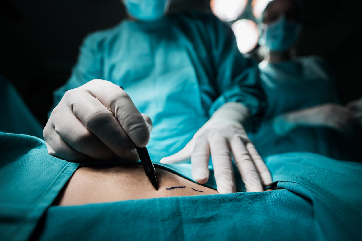 Close up of a doctor marking the human skin. Liposuction is a common cosmetic procedure. (iStock)
