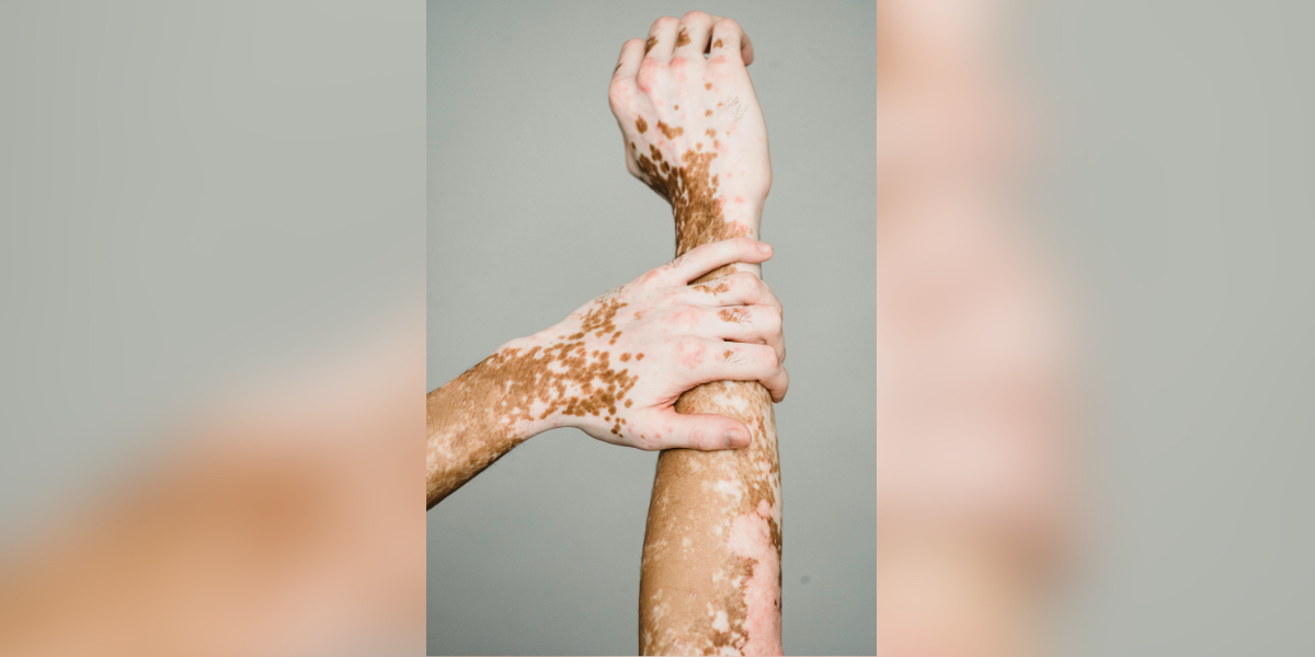 World Vitiligo Day: Yet another gut health win (Pexels- Armin Rimoldi) World Vitiligo Day: Yet another gut health win (Pexels- Armin Rimoldi)