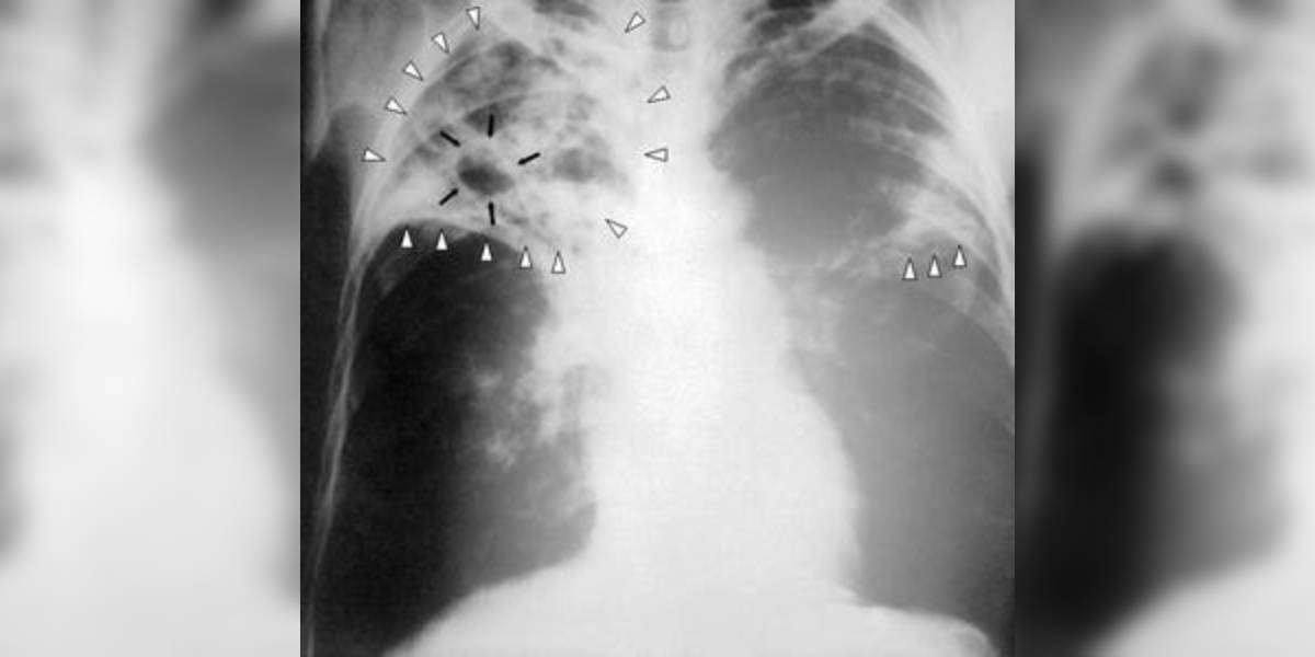 India's focus in on early detection of tuberculosis, timely treatment and improved patient support.