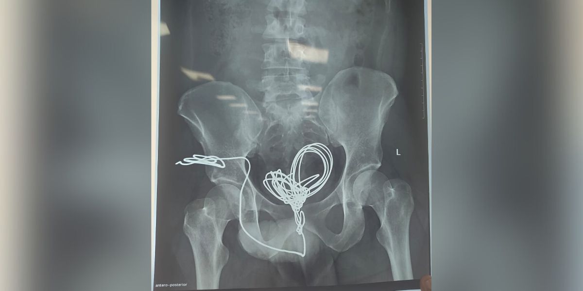 wire inside bladder