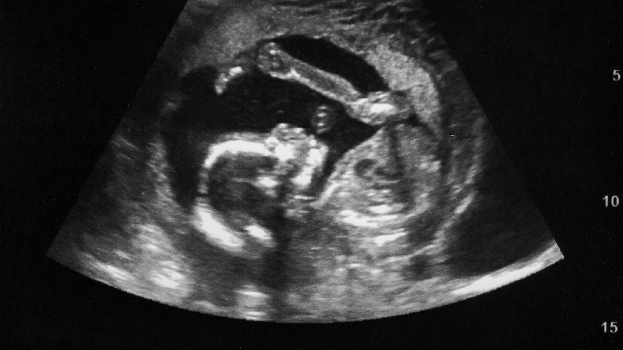 Ultrasound with pregnancy Obstetric of fetus Medical images. pregnant mother. Stillbirths show India’s north–south divide in maternal healthcare, literacy