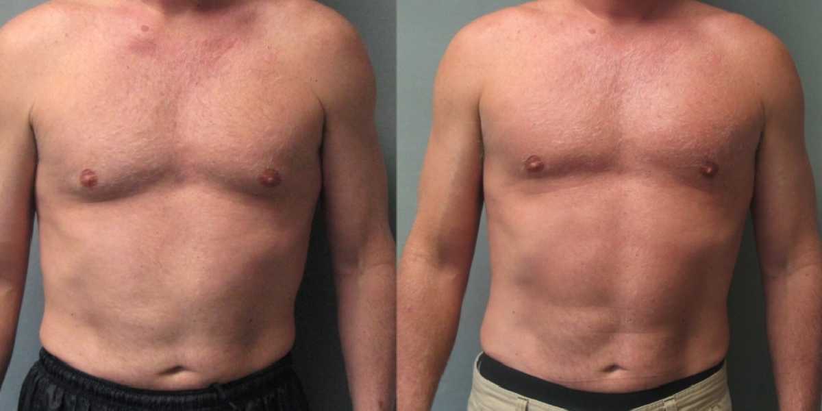 Shedding stigma: Male breast reduction is India’s fifth most common cosmetic surgery