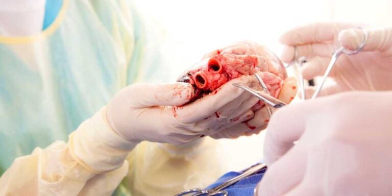 organ transplant