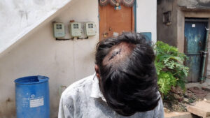 Shakthiraj suffered a head injury, which required eight stitches.