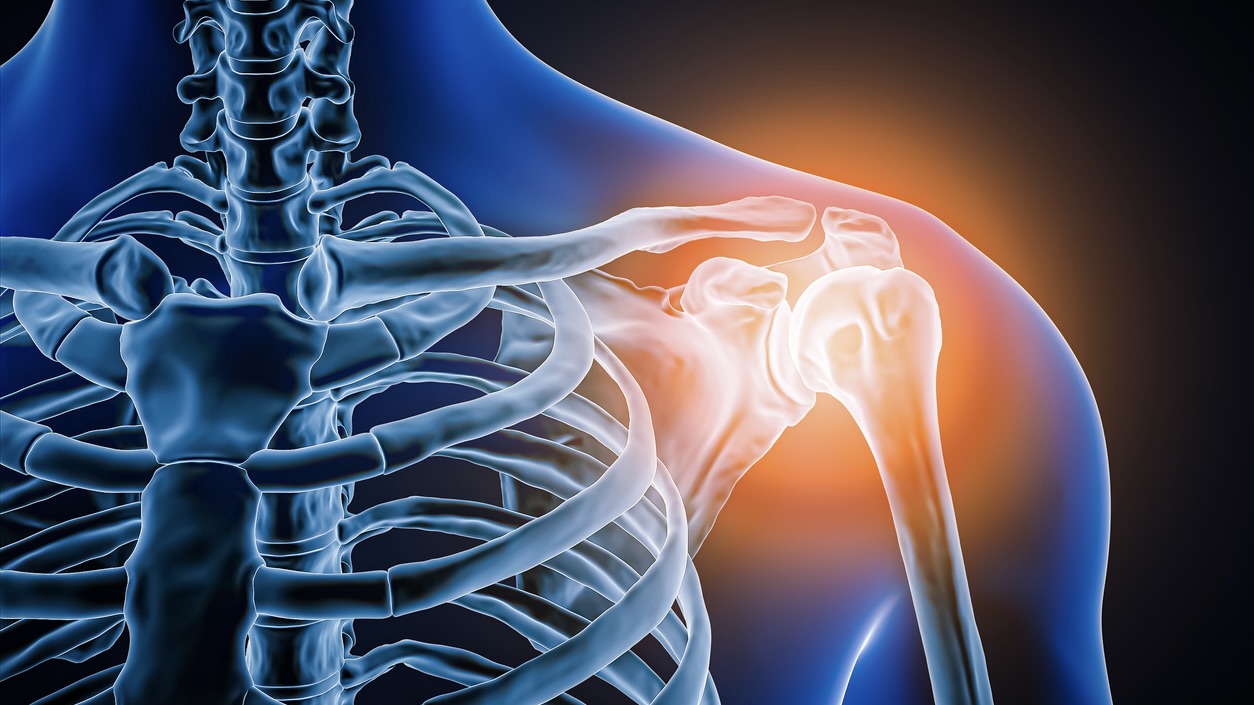 The patient was diagnosed with bilateral primary shoulder osteoarthritis, a rare condition that affects only one in 10,000 to one in 100,000 individuals.