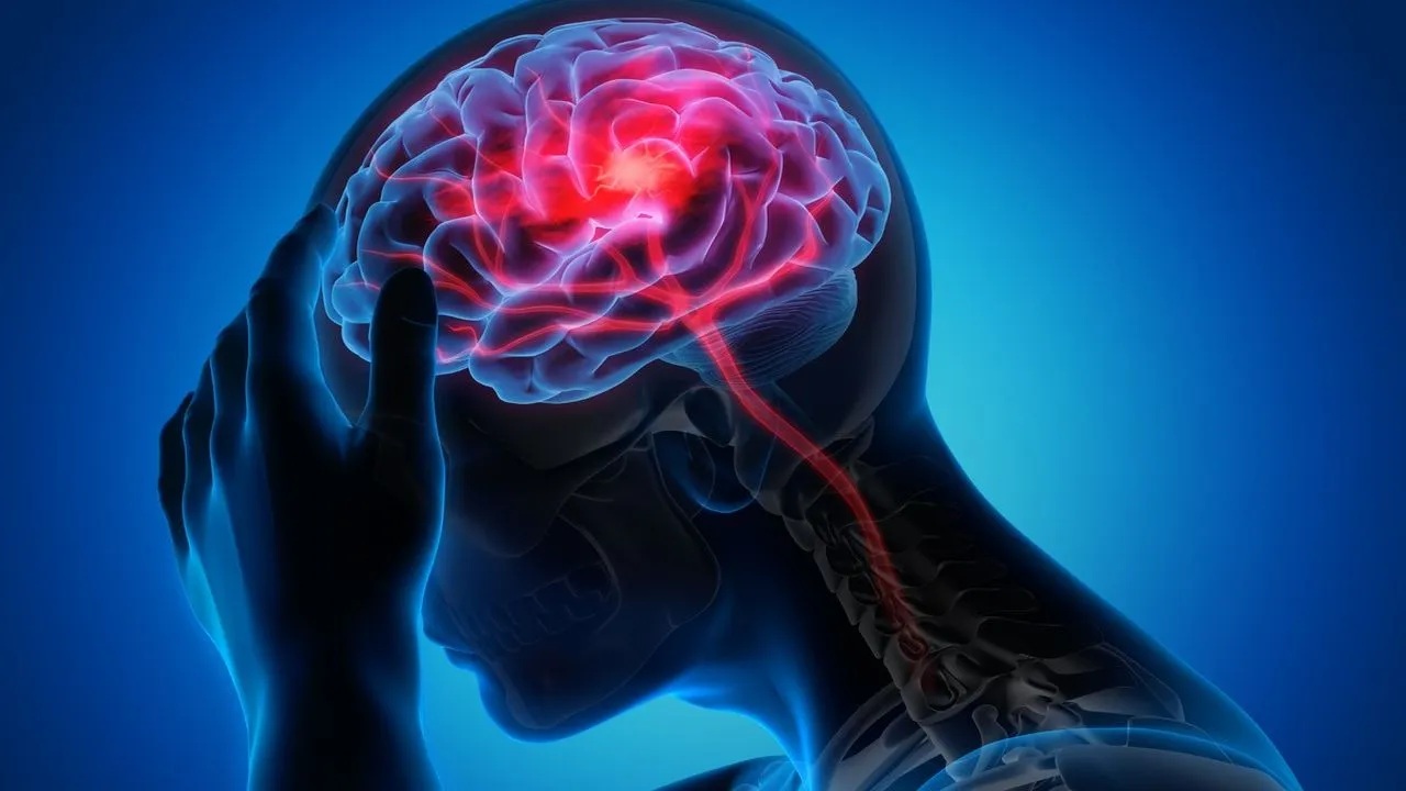 A stroke occurs when blood flow to a part of the brain is interrupted—either due to a blockage (ischemic stroke) or bleeding (hemorrhagic stroke). When this happens, brain cells begin to die within minutes.