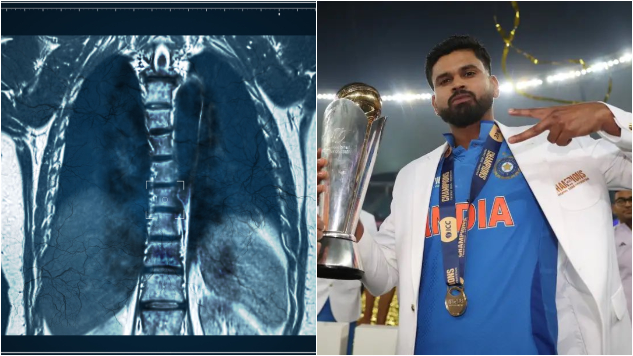 In Shreyas Iyer’s case, early diagnosis meant doctors could manage the injury conservatively, without surgery. Credit: iStock, x.com/ShreyasIyer15