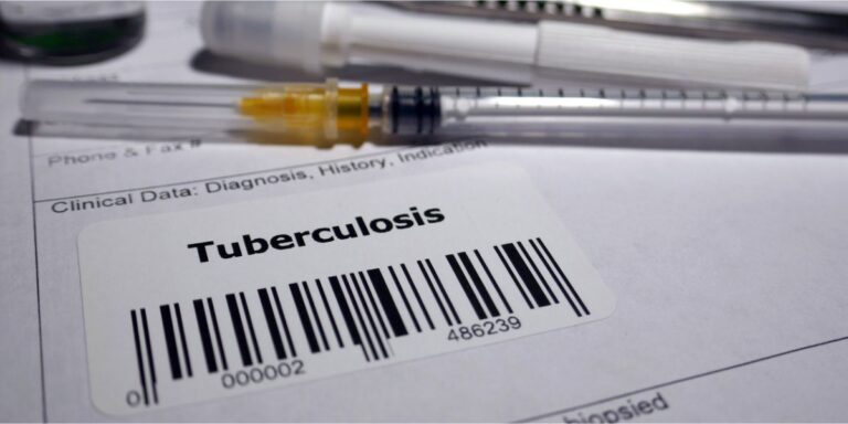 Tuberculosis