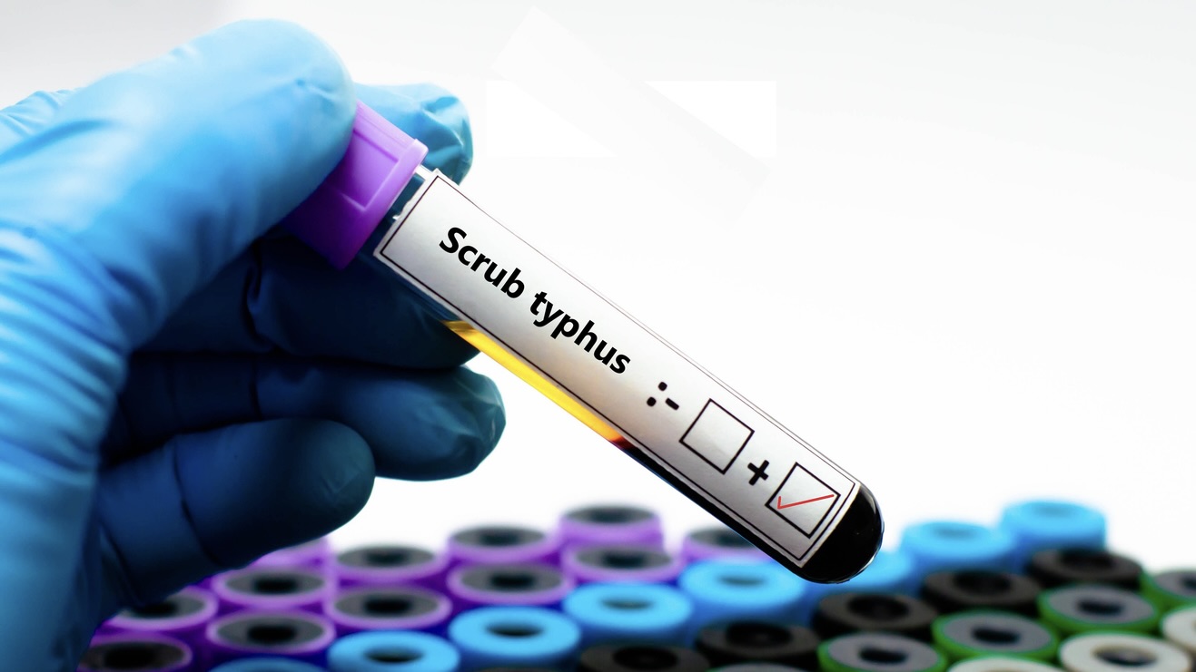 Scrub typhus returns to Andhra Pradesh every monsoon. Rain saturates fields and vegetation, creating conditions in which chigger mites thrive.