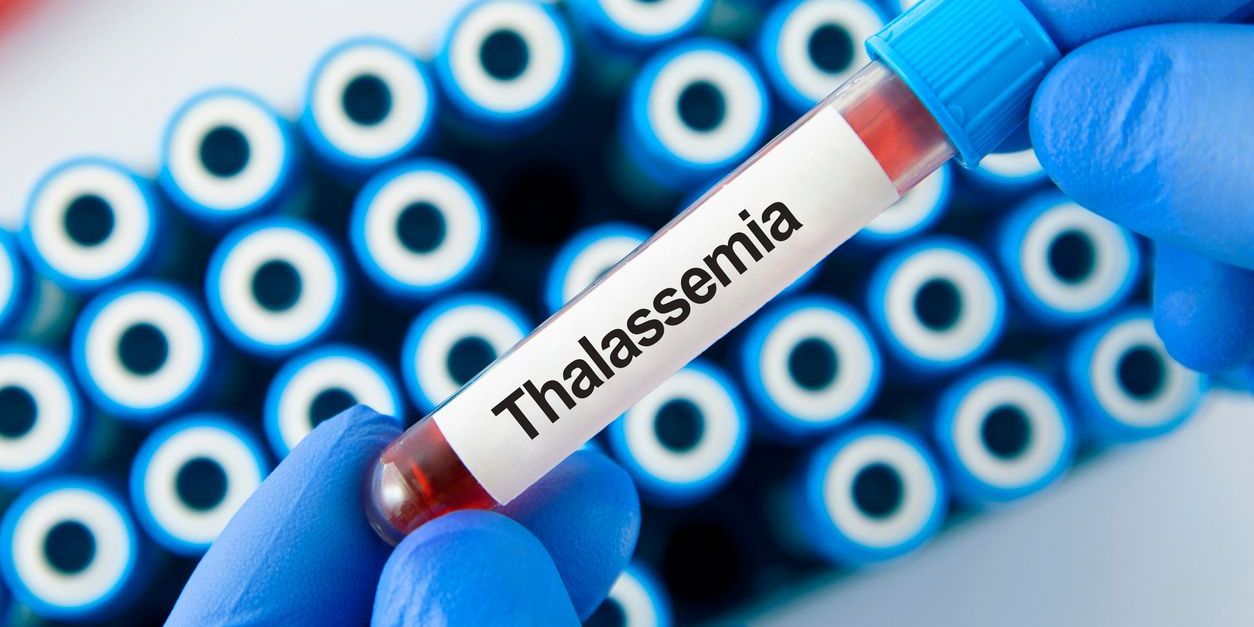 Thalassemia.