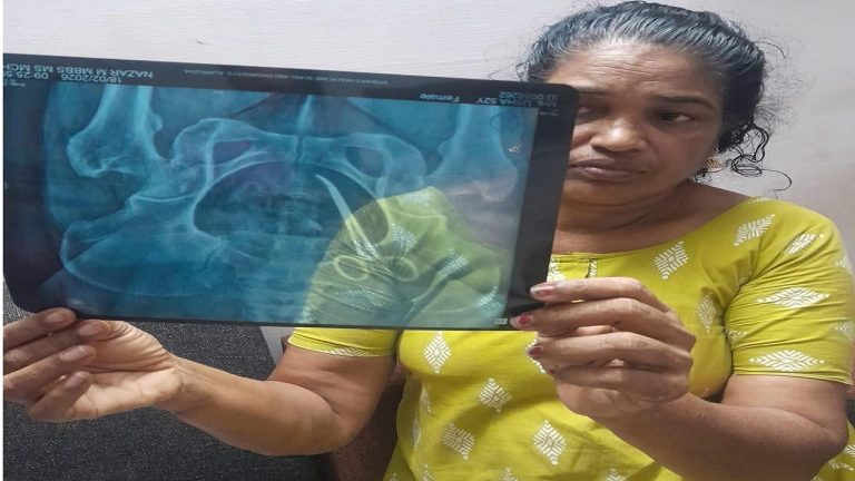 A case of suspected medical negligence has come to light after a surgical scissor was discovered inside the abdomen of a 51 year-old woman