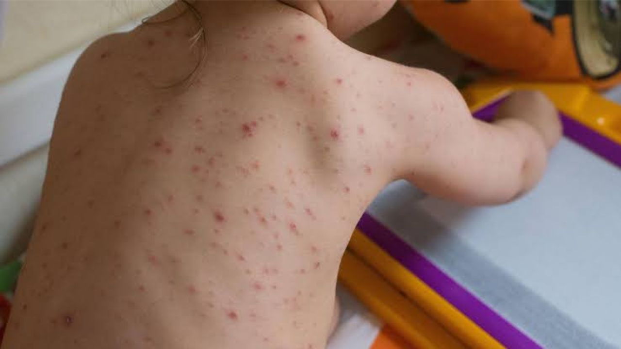 Chickenpox. Representative Image.