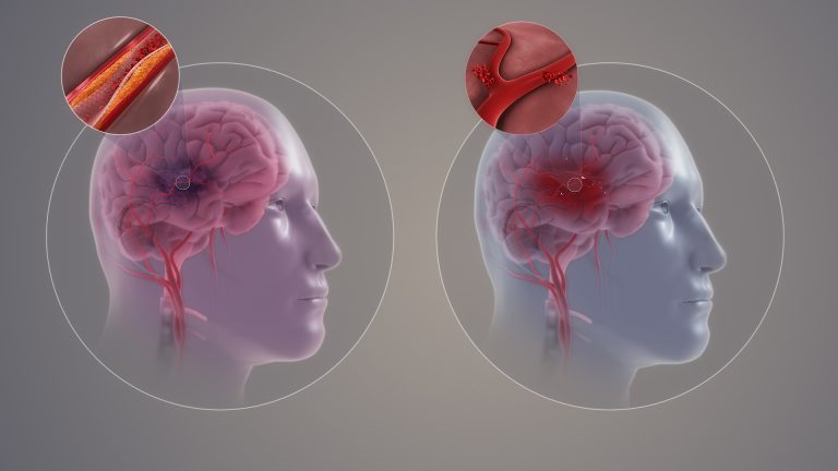 Kerala's Health Minister K Muraleedharan said there is an increase in stroke cases among the youth.