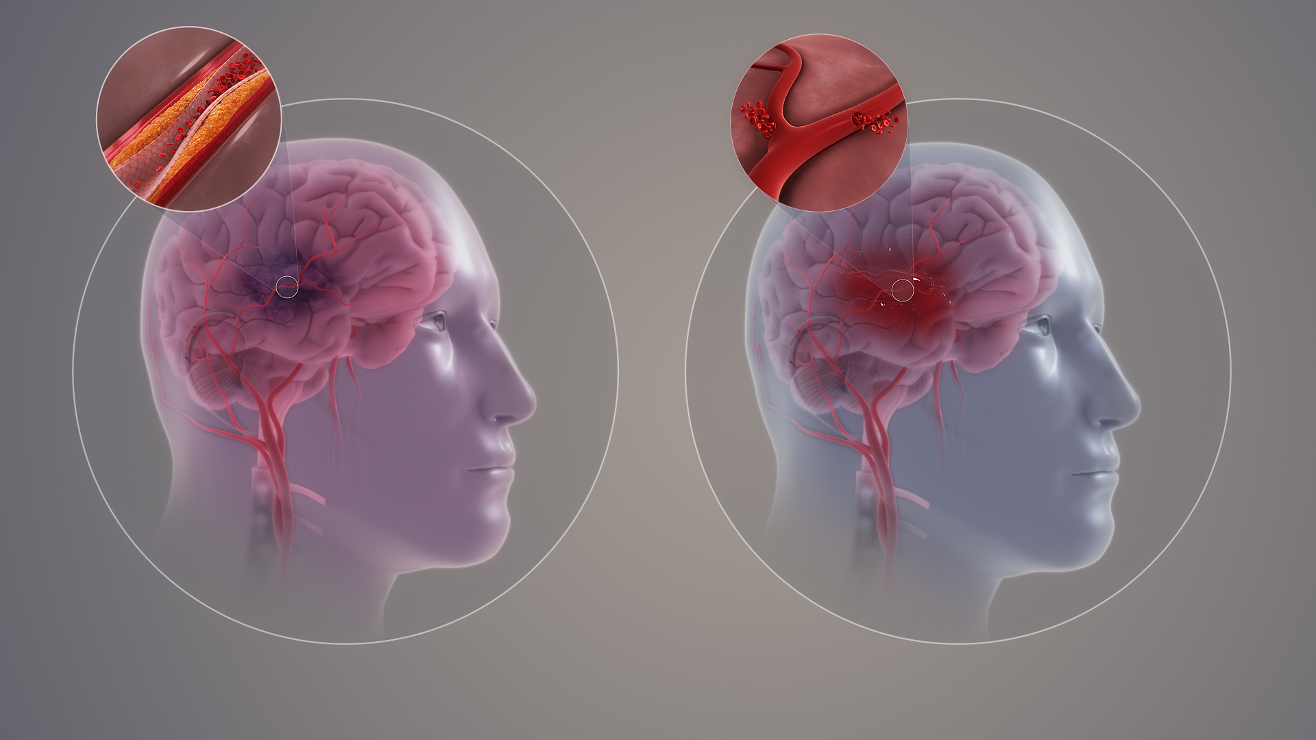 Kerala's Health Minister K Muraleedharan said there is an increase in stroke cases among the youth.