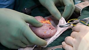 'My husband works, I can manage': AIIMS study moots wider research on gender divide among kidney donors