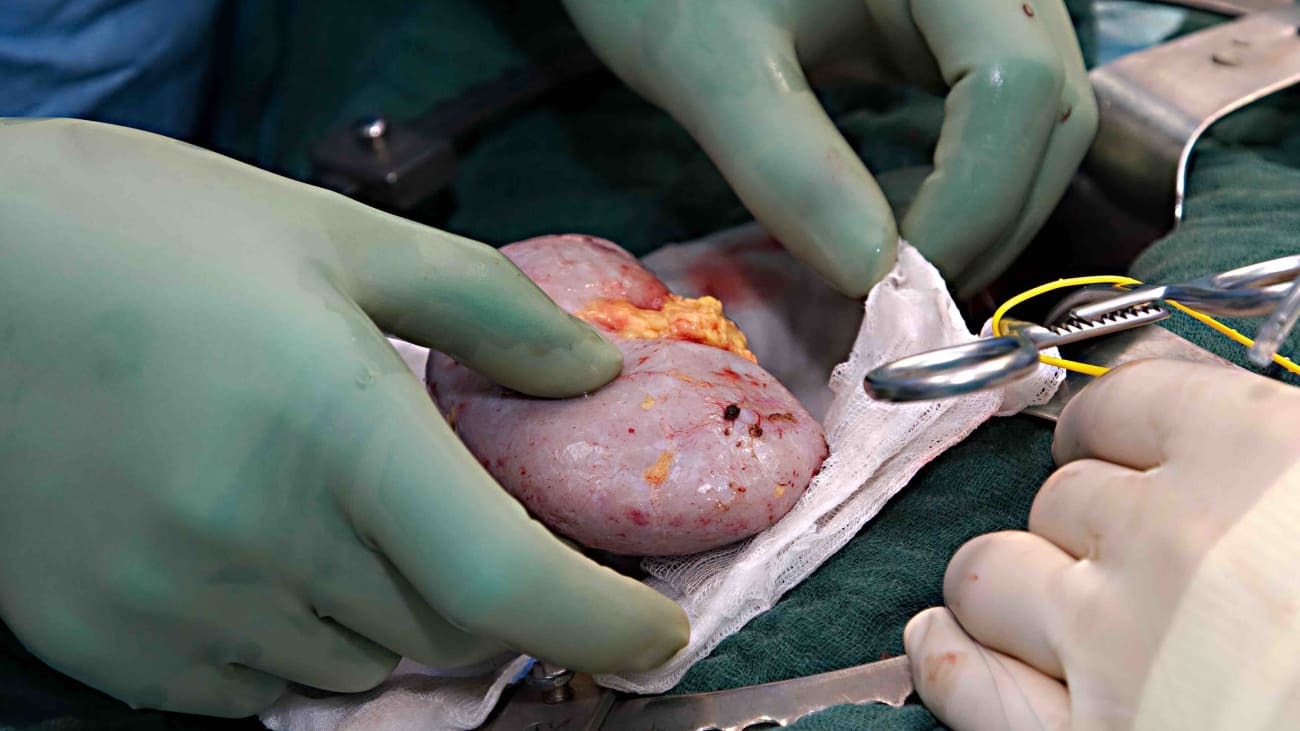 The study found that 79% of kidney donors were women, while men comprised 81.5% of the recipients. (Wikimedia Commons)