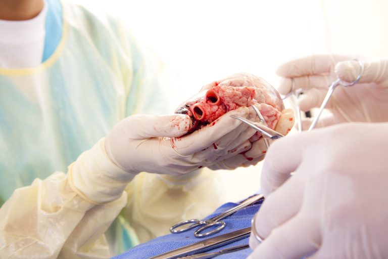 The procedure involved transplanting the stomach, duodenum, pancreas, small bowel and right colon into a 30-year-old engineer from Sircilla.
