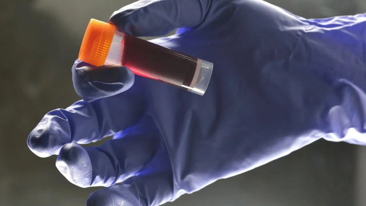 Blood Cancer : ఈ 7సంకేతాలు కనిపిస్తున్నాయా.. అయితే మీకు బ్లడ్ క్యాన్సర్ అవకాశం ఉన్నట్లే Blood Cancer : ఈ 7సంకేతాలు కనిపిస్తున్నాయా.. అయితే మీకు బ్లడ్ క్యాన్సర్ అవకాశం ఉన్నట్లే