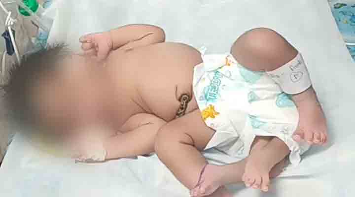 Infant | నాలుగు కాళ్లతో జన్మించిన ఆడ శిశువు Infant | నాలుగు కాళ్లతో జన్మించిన ఆడ శిశువు