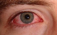 Pink Eye | కళ్లకలకలు వస్తే సొంత వైద్యం వద్దు.. వైద్యుల హెచ్చరిక Pink Eye | కళ్లకలకలు వస్తే సొంత వైద్యం వద్దు.. వైద్యుల హెచ్చరిక
