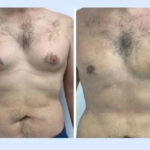 Post-Operative Guidance From the Best Gynecomastia Surgeon in Dubai