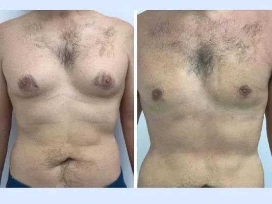 Post-Operative Guidance From the Best Gynecomastia Surgeon in Dubai