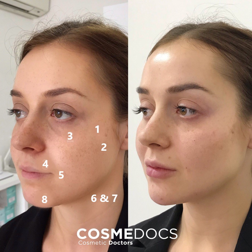Facelift Surgery: Restore Youth, Shape, and Confidence