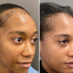 The Role of the Best Plastic Surgeon in Enhancing Chemical Peel Treatment in Dubai