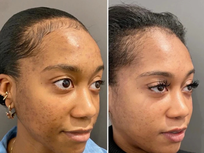 The Role of the Best Plastic Surgeon in Enhancing Chemical Peel Treatment in Dubai