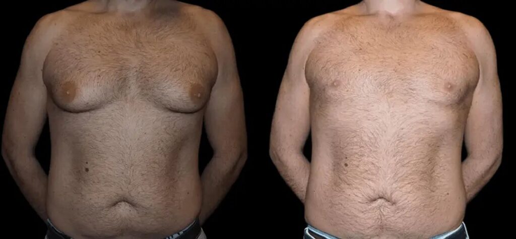 The Best Gynecomastia Surgeons in dubai: Precision and Perfection
