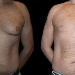 The Best Gynecomastia Surgeons in dubai: Precision and Perfection