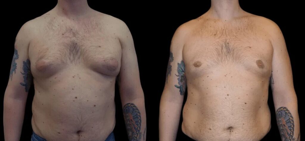 Why the Best Gynecomastia Surgeons in dubai Leads in Male Aesthetics