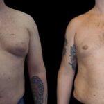 Why the Best Gynecomastia Surgeons in dubai Leads in Male Aesthetics