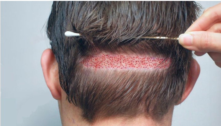 hybrid hair transplant