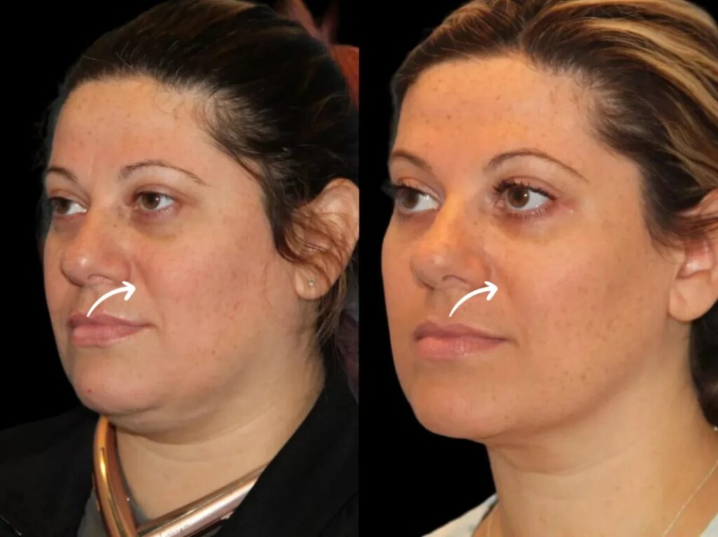 Best Aesthetic Clinics in Dubai Sculptra for Natural Cheeks