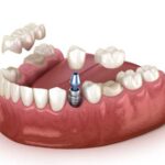 The Revolutionary Impact of Dental Implants in York