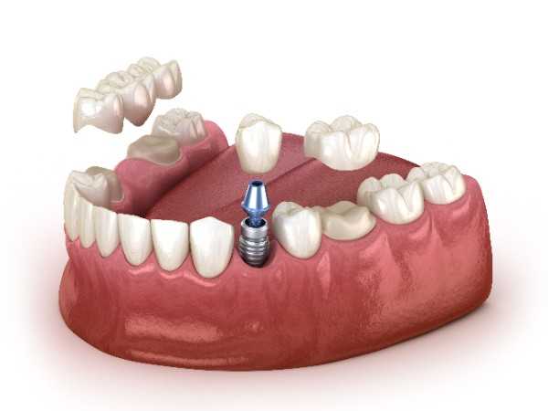 The Revolutionary Impact of Dental Implants in York
