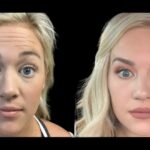 Botox for Men: A Growing Trend at the Best Aesthetic Clinics in Dubai