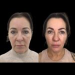 Secure Skin Lasting Glow with the Profhilo by Best Plastic Surgeons in dubai
