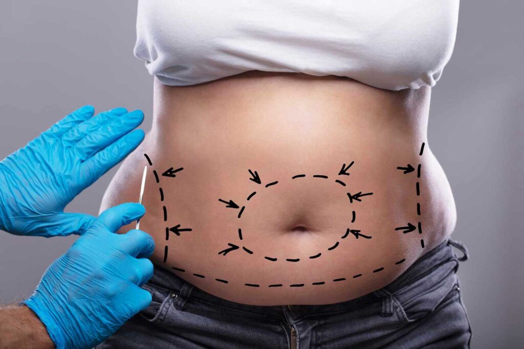 Tummy Tuck Dubai: Before and After Transformation Results