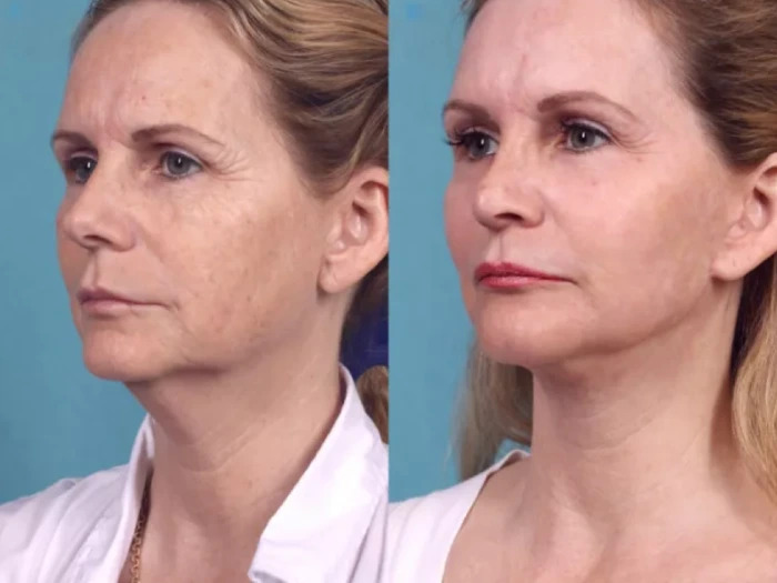 How the Best Plastic Surgeon in Dubai Treats Acne Scars With Chemical Peels