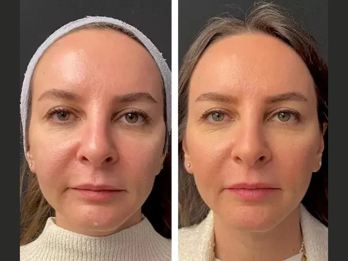 Mesotherapy for Bright, Youthful Skin: Recommendations from the Best Plastic Surgeon in Dubai