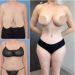 Best Tummy Tuck Surgeon in Dubai for Smooth and Firm Results