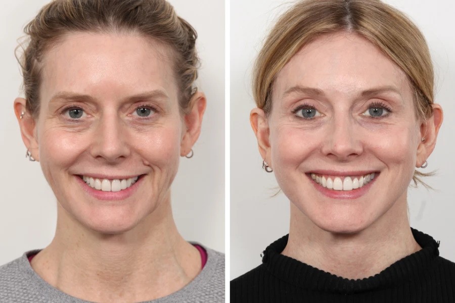 Thread Lift Treatment in Dubai for Advanced Skin Tightening