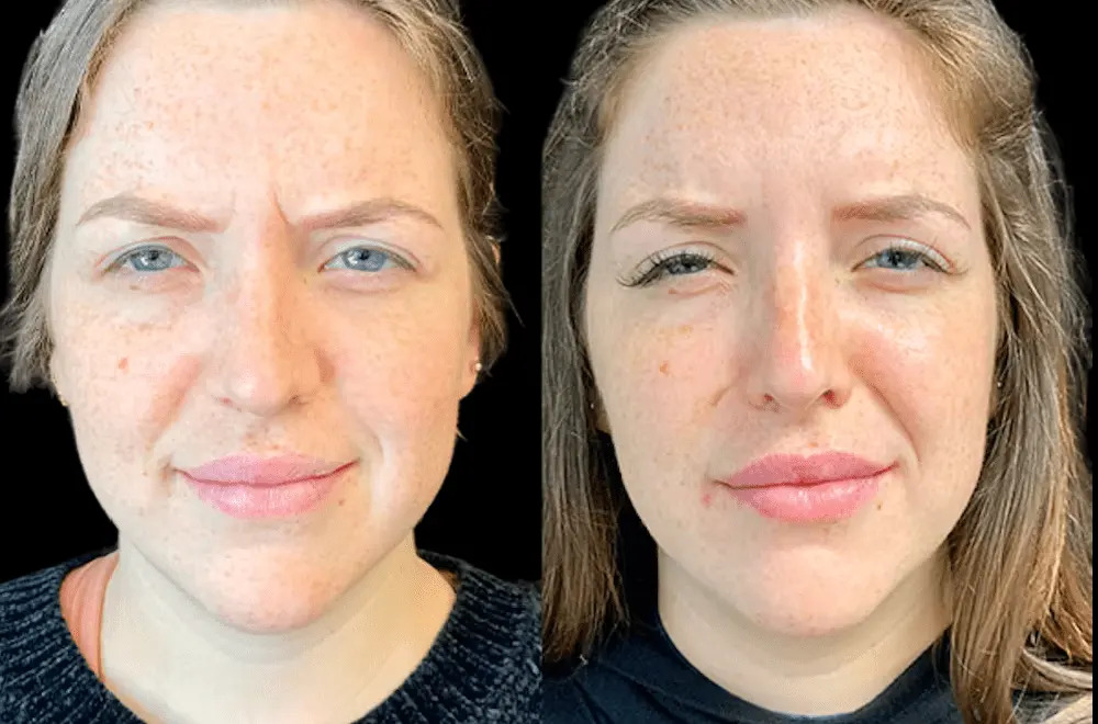 How to Choose the Best Clinic for Botox Treatment in Dubai