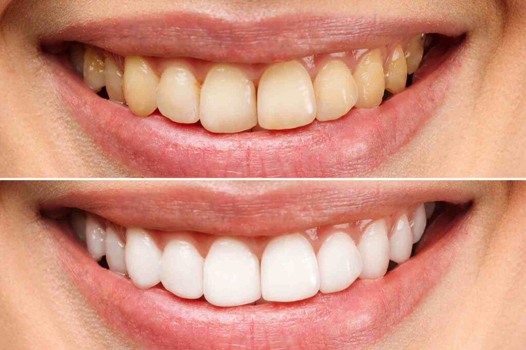 What Causes Yellow Teeth – And How to Reverse It